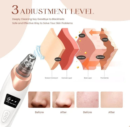 5-Level Facial Pore Vacuum